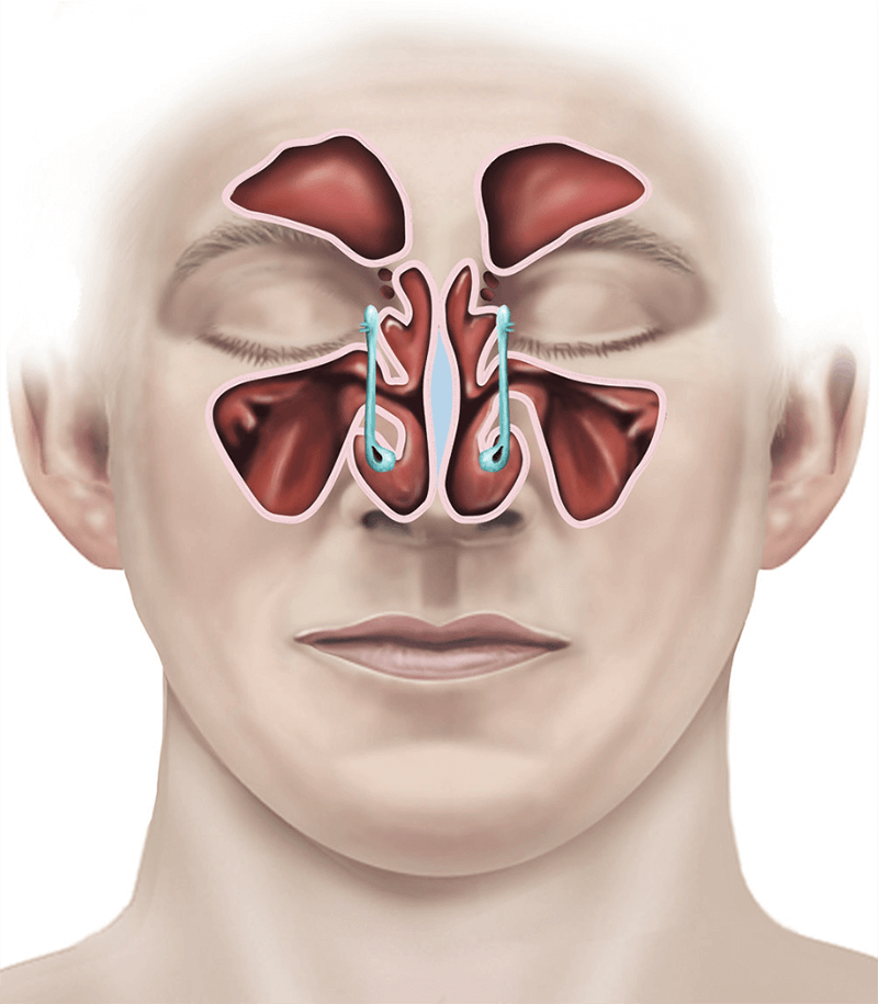 Sinusitis Treatment